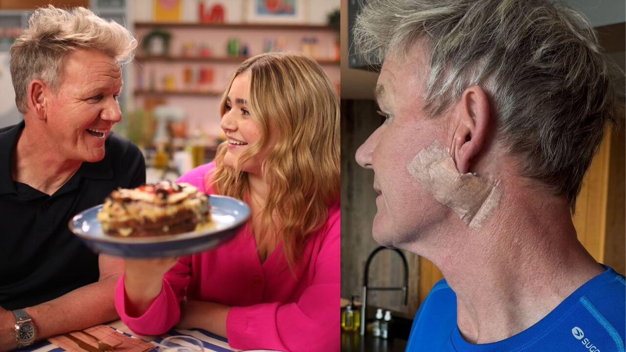 Gordon Ramsay Skin Cancer: Take Sun Protection Seriously! 5 Gordon Ramsey Skin Cancer