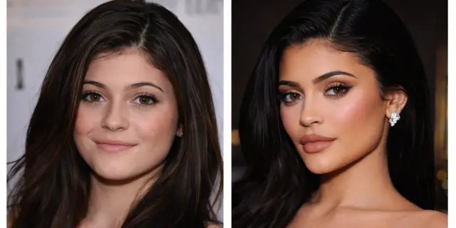 Kylie Jenner Before Afte