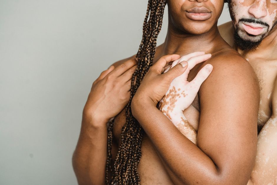 can psoriasis cause hair loss