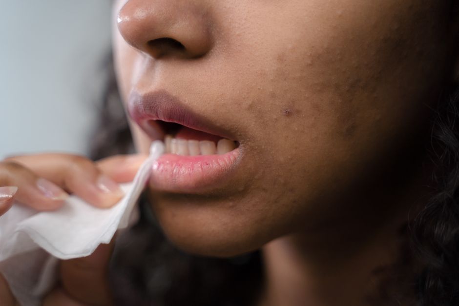 how to remove a hickey in seconds with toothpaste