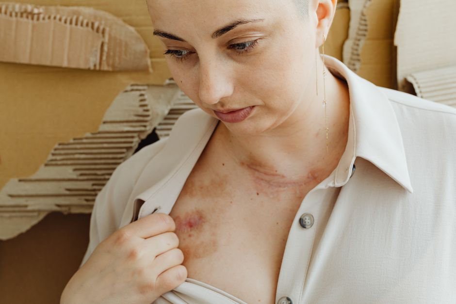 do benign tumours grow