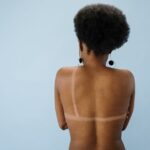 do black people get sunburns