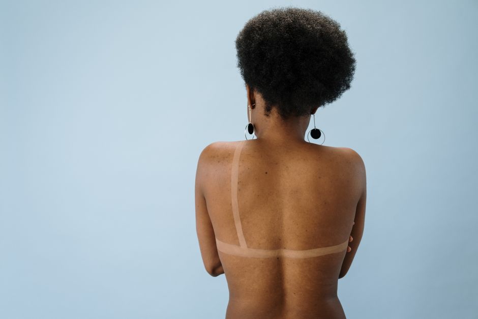 do black people get sunburns