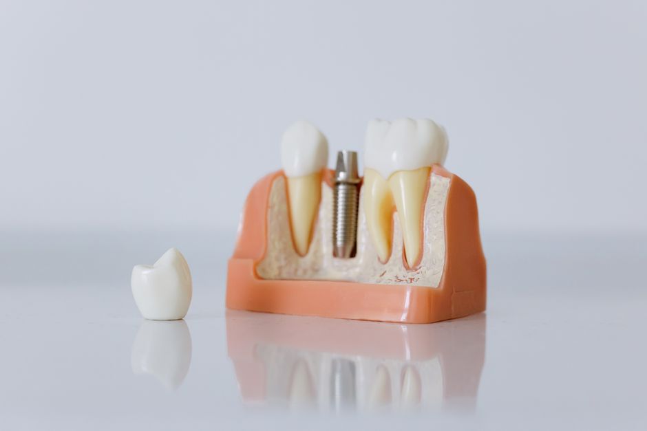 how much would a dental bridge cost