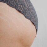 how to get rid of pimples on your butt fast