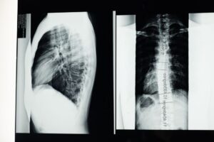 is scoliosis genetic or hereditary