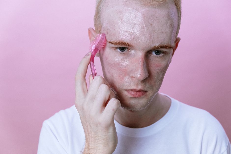 what causes hormonal acne androgens diet and stress