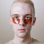 what does inflammatory acne look like