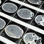 what is cerebral atherosclerosis symptoms treatment