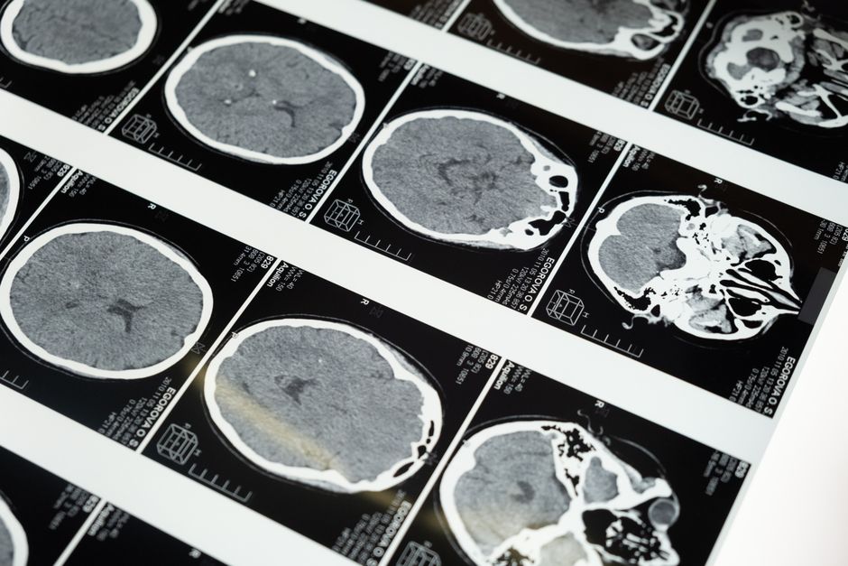what is cerebral atherosclerosis symptoms treatment
