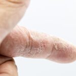why is your skin peeling on your hands