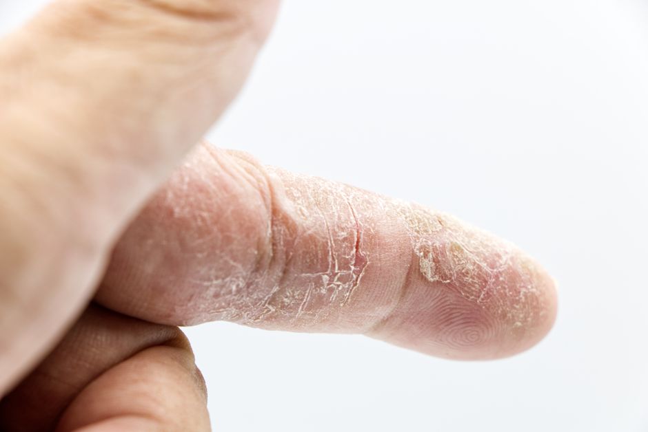 why is your skin peeling on your hands
