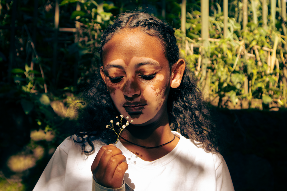 can lupus cause vitiligo the autoimmune link