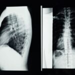 can scoliosis be cured