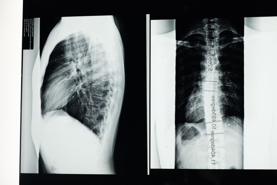 does scoliosis cause back pain