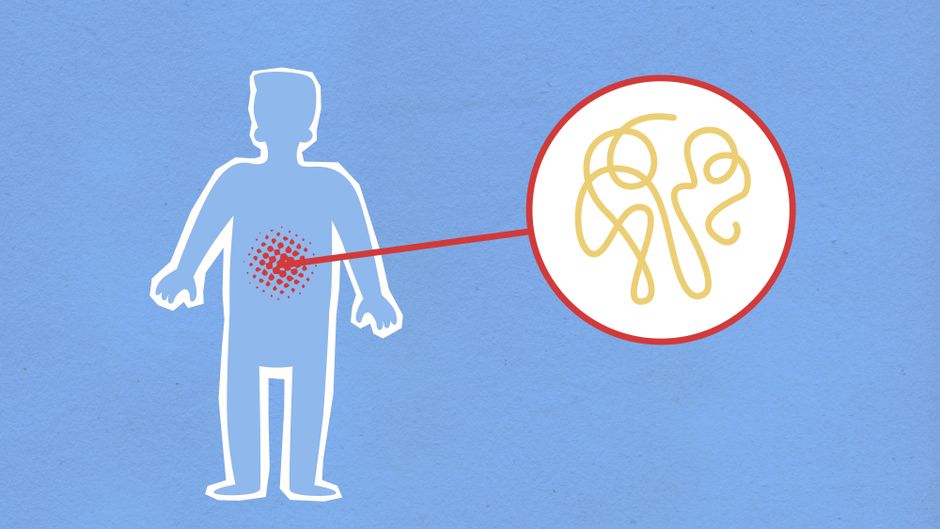 how are stomach ulcers diagnosed endoscopy and more