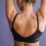 how common is back acne and who does it affect