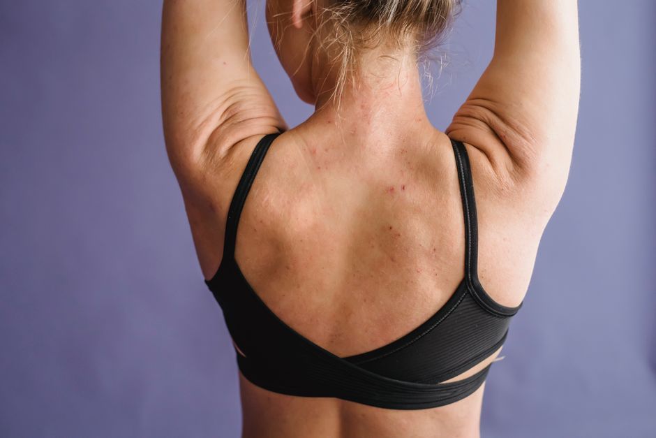how common is back acne and who does it affect