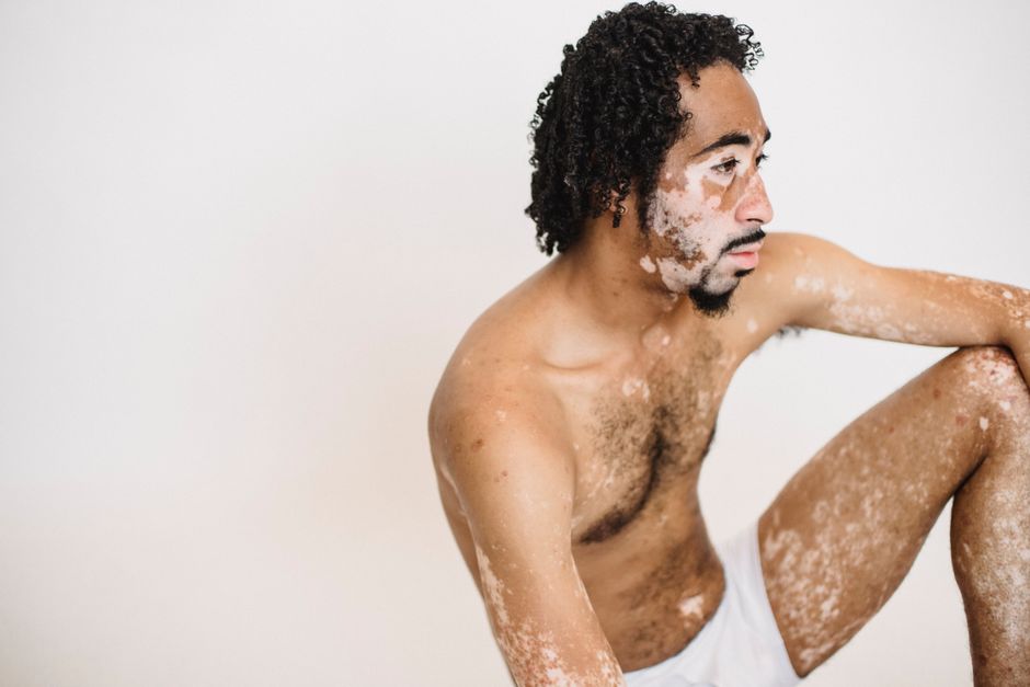 how do people get vitiligo causes and triggers