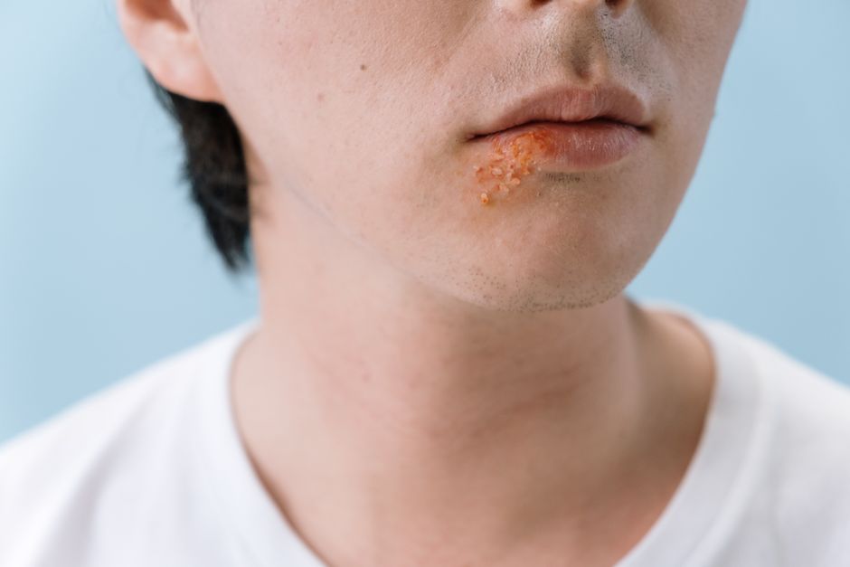 how does valacyclovir work to stop the herpes virus