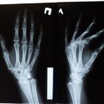 how many bones in the hand