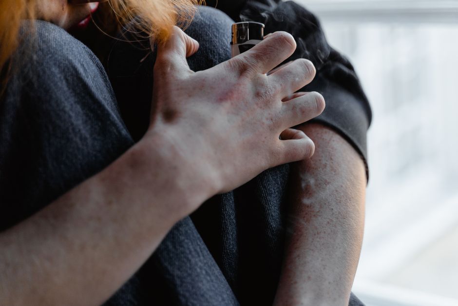 how to get asphalt off skin safely
