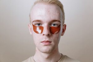how to get rid of under the skin acne for good