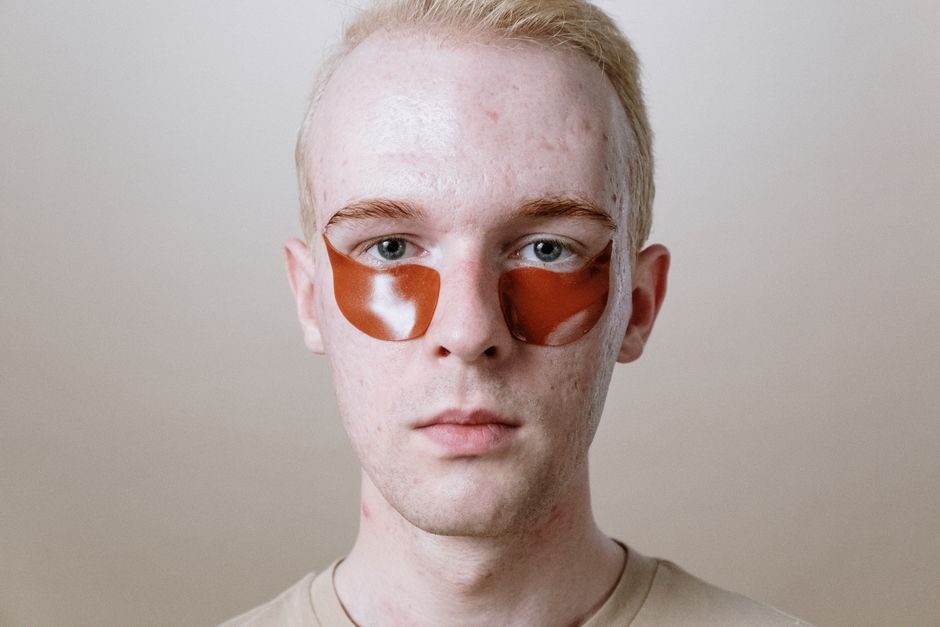 how to get rid of under the skin acne for good