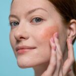 how to manage rosacea flares and reduce redness