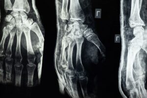 How To Prevent Bone Fractures Diet Exercise More? 6 how to prevent bone fractures diet exercise more