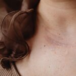 how to release scar tissue methods treatments
