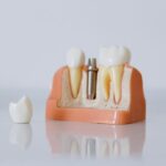 how to replace a missing tooth yourself