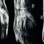 how to tell if a bone is fractured or bruised