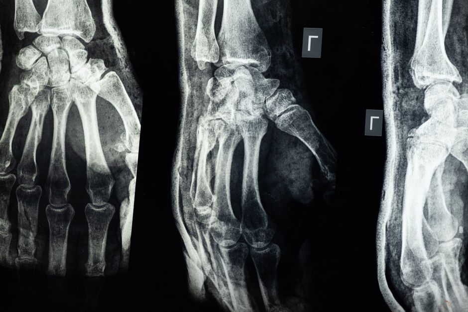 how to tell if a bone is fractured or bruised