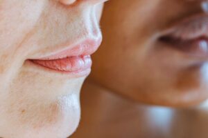 how to treat angular cheilitis and stop it returning