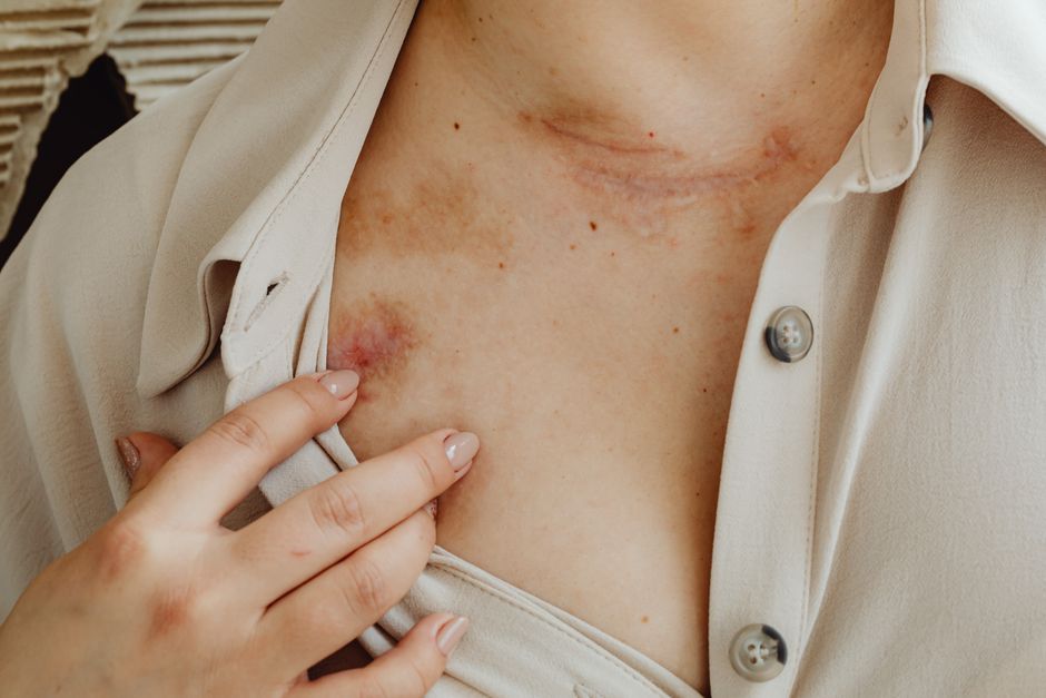 how to use skin glue on a wound step by step