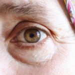 what are crows feet causes prevention treatment