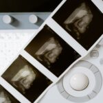 what are the key eye features of fetal alcohol syndrome