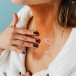 what are varices in esophagus