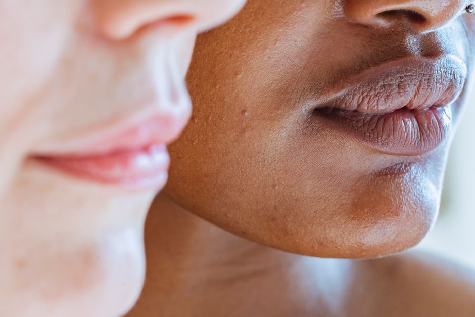 what causes face bumps acne milia and more