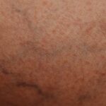what causes varicose veins in legs