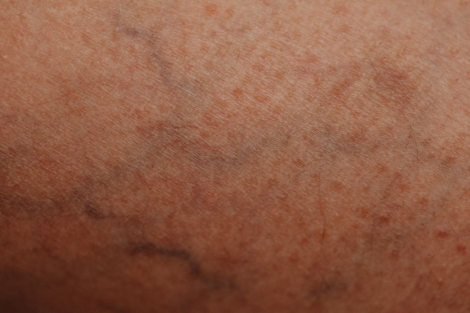 what causes varicose veins in legs