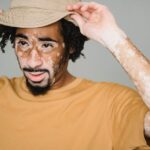 what causes vitiligo to appear later in life