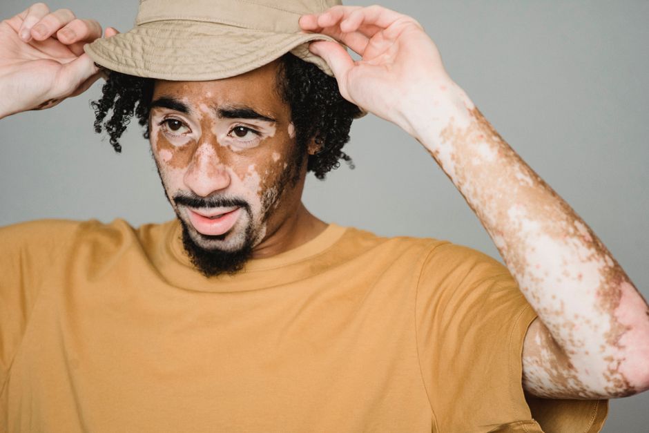what causes vitiligo to appear later in life