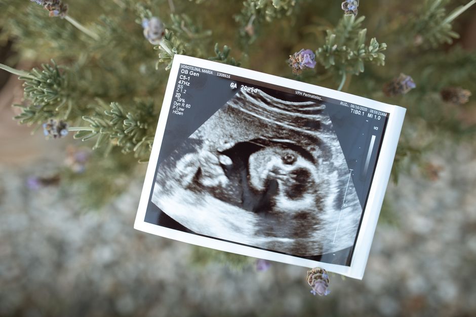 what does a 13 week fetus look like on ultrasound