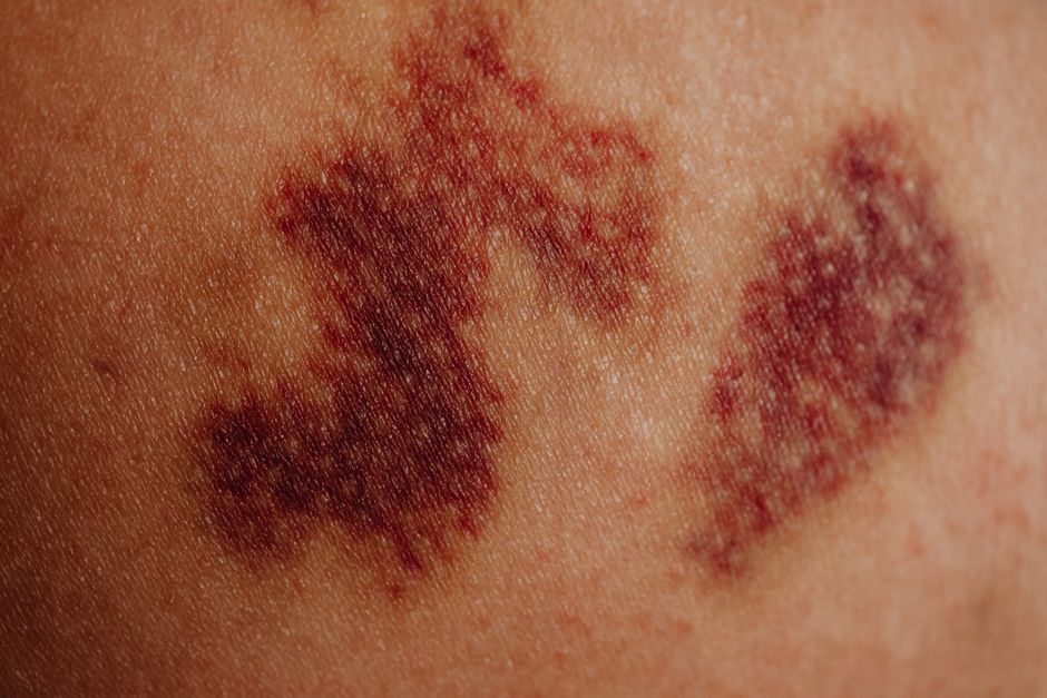 what does a bone bruise feel like