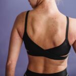 what does prurigo nodularis look like on all skin tones