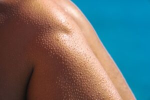 What Does Uneven Skin Texture Look Like Bumps Pits More? 2 what does uneven skin texture look like bumps pits more
