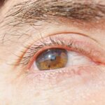 what is a blown pupil