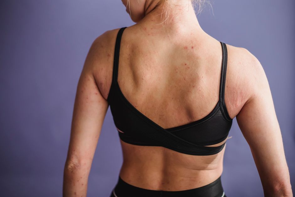 what is eczema look like
